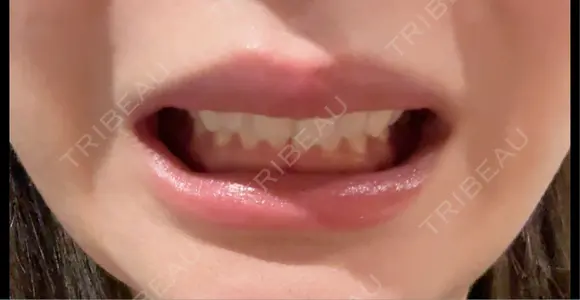 ボトックス（口角） BON BON CLINIC 渋谷院 DAY 4 メイン用