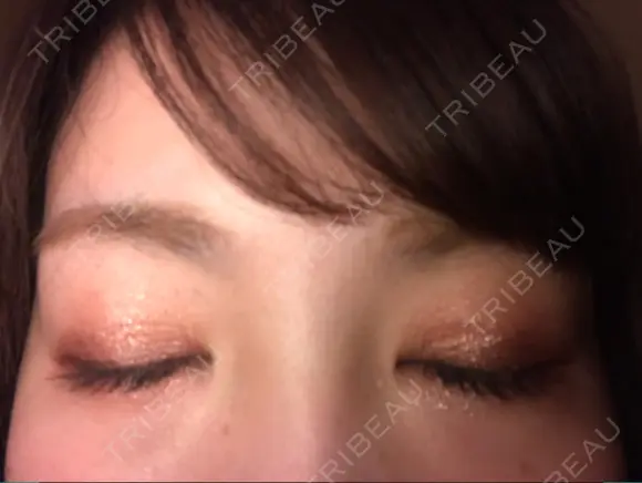 二重埋没 城本クリニック 大阪院 DAY 70 メイン用