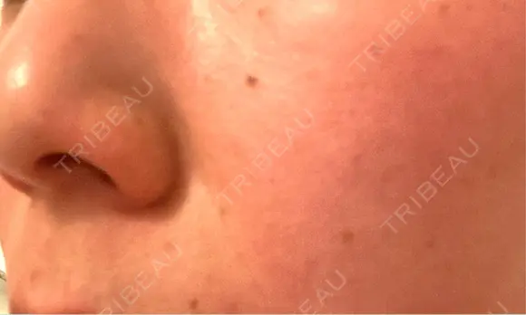 ピーリング（ニキビ・毛穴） / エレクトロポレーション / 光治療（フォトフェイシャルなど） 共立美容外科 仙台院 DAY 0 メイン用