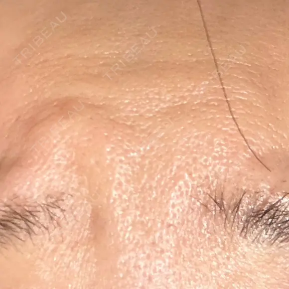 ボトックス（エラ・小顔） / ボトックス（眉間） / ボトックス（目尻） / ボトックス（額） ルラ美容クリニック 郡山院 DAY 1 メイン用