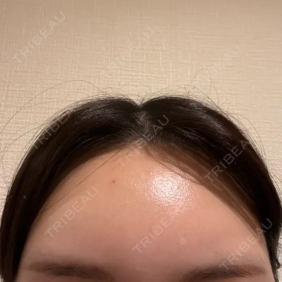 ヒアルロン酸注入（額） / ヒアルロン酸注入（こめかみ） Moon Beauty Clinic AFTER メイン用