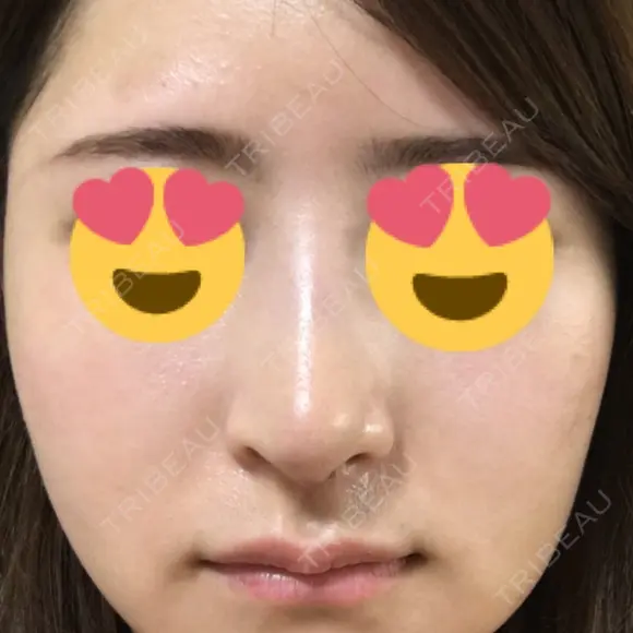 隆鼻術 / 鼻尖形成（切開） / 鼻中隔延長（切開） / 斜鼻修正 / 眉間プロテーゼ / その他（鼻） FROM B整形外科 (旧バウム整形外科) DAY 12 メイン用