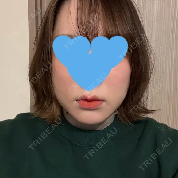 糸リフト / 脂肪吸引（顔） / ジョールファット除去 / 脂肪吸引注射（顔） SEA CLINIC（シークリニック） DAY 7 メイン用