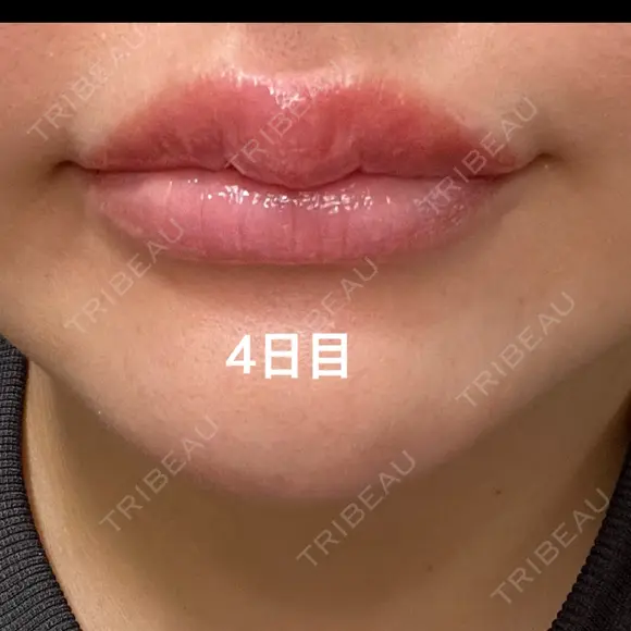 アートメイク（唇） / アートメイク（アイライン） Kinshicho Beauty Clinic （錦糸町ビューティークリニック） AFTER メイン用