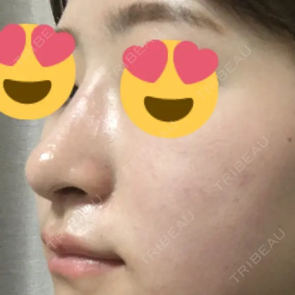 隆鼻術 / 鼻尖形成（切開） / 鼻中隔延長（切開） / 斜鼻修正 / 眉間プロテーゼ / その他（鼻） FROM B整形外科 (旧バウム整形外科) DAY 33 メイン用