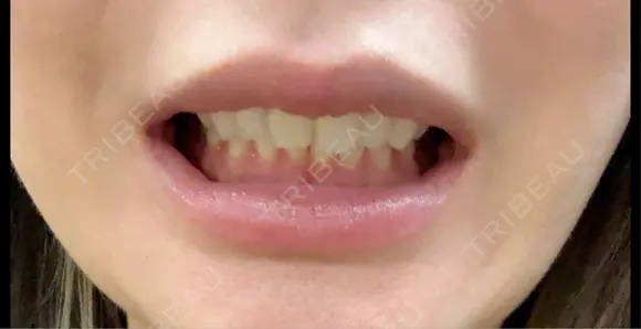 ボトックス（口角） BON BON CLINIC 渋谷院 DAY 5 メイン用