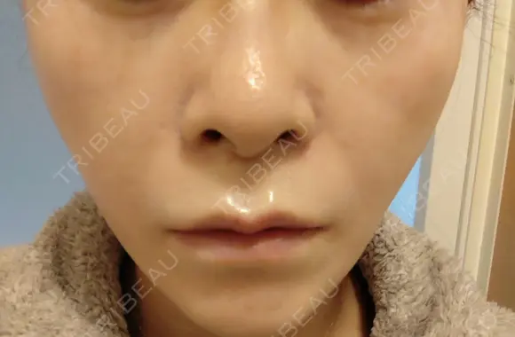 糸リフト 形成外科と美容外科のクリニック池袋 DAY 2 メイン用