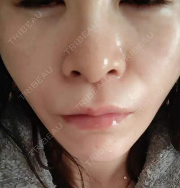 糸リフト 形成外科と美容外科のクリニック池袋 DAY 3 メイン用