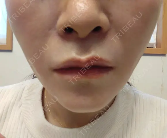 糸リフト 形成外科と美容外科のクリニック池袋 DAY 5 メイン用