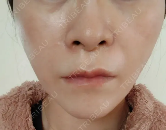 糸リフト 形成外科と美容外科のクリニック池袋 DAY 6 メイン用