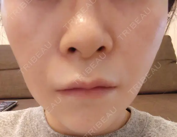 糸リフト 形成外科と美容外科のクリニック池袋 DAY 9 メイン用