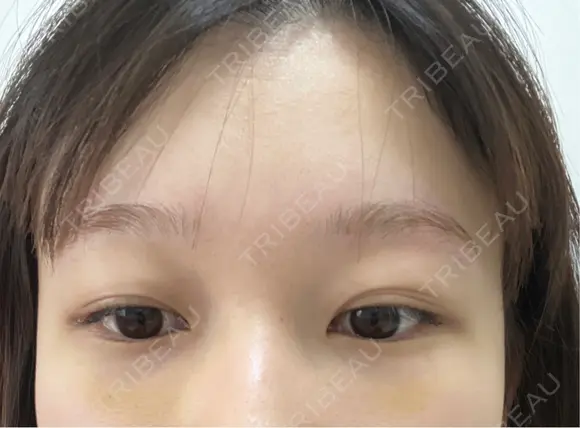 クマ治療 APOLLO BEAUTY CLINIC DAY 9 メイン用