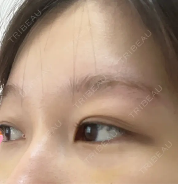 クマ治療 APOLLO BEAUTY CLINIC DAY 9 メイン用