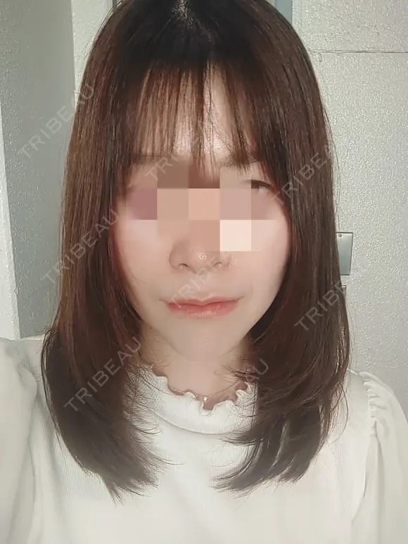 糸リフト 形成外科と美容外科のクリニック池袋 AFTER メイン用