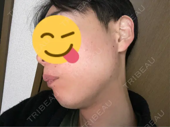 光治療（フォトフェイシャルなど） / 医療脱毛（全身） しんゆり美容健康クリニック AFTER メイン用