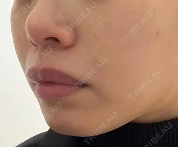 光治療（フォトフェイシャルなど） 品川美容外科 渋谷院（※品川スキンクリニック提携） DAY 0 メイン用