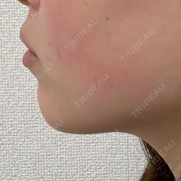 ボトックス（あご） / ヒアルロン酸注入（あご） / ボトックス（エラ・小顔） Next Tokyo Clinic AFTER メイン用