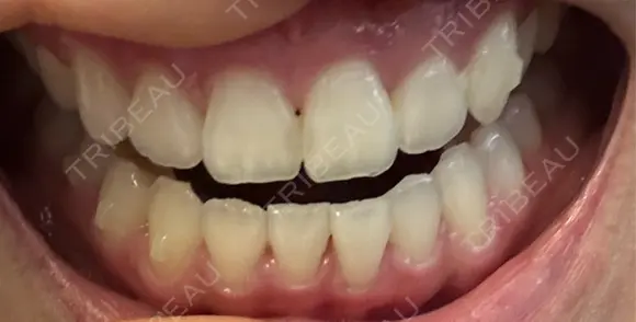 矯正（マウスピース） 湘南歯科クリニック 池袋院 AFTER メイン用