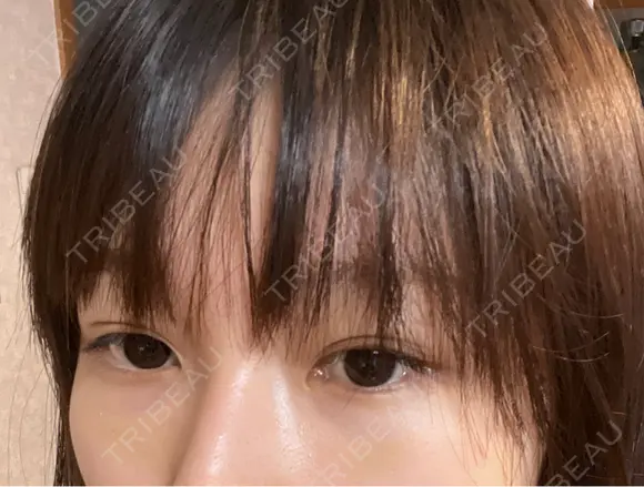 クマ治療 APOLLO BEAUTY CLINIC DAY 10 メイン用