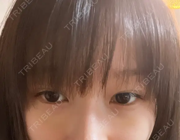 クマ治療 APOLLO BEAUTY CLINIC DAY 10 メイン用