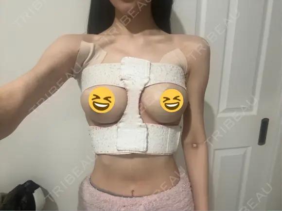 豊胸（シリコンバッグ） お茶の水美容形成クリニック DAY 3 メイン用