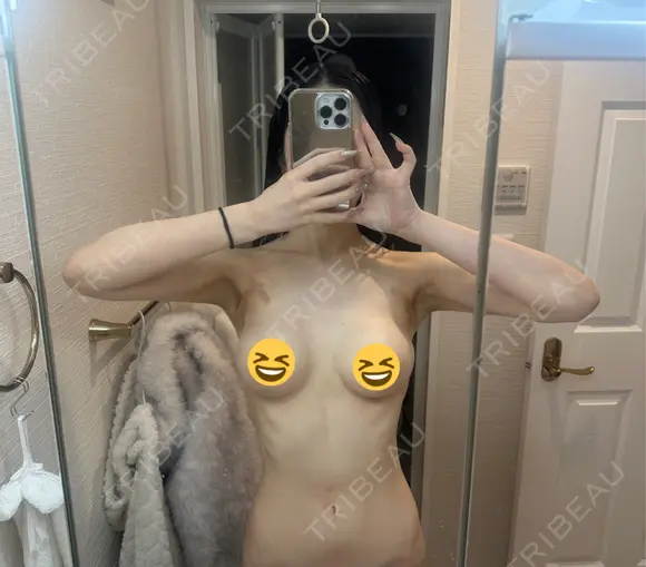 豊胸（シリコンバッグ） お茶の水美容形成クリニック DAY 4 メイン用