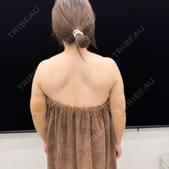 脂肪吸引（二の腕） EMMA CLINIC（エマクリニック） DAY 3 メイン用