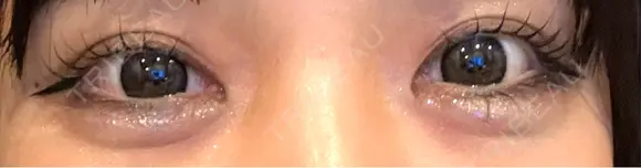 ヒアルロン酸注入（涙袋） プライベートスキンクリニック 梅田本院 DAY 0 メイン用