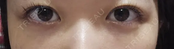 脂肪注入（目の下） ルラ美容クリニック 札幌本院 DAY 35 メイン用