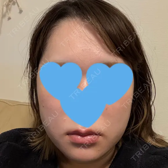 糸リフト / 脂肪吸引（顔） / ジョールファット除去 / 脂肪吸引注射（顔） SEA CLINIC（シークリニック） DAY 10 メイン用