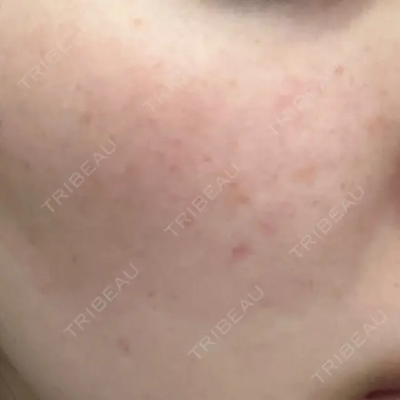 ルメッカ 大美会クリニック 京都烏丸院 DAY 0 メイン用