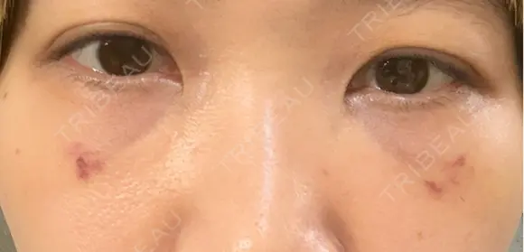 クマ治療 池袋麗歯科・美容皮膚科 DAY 18 メイン用