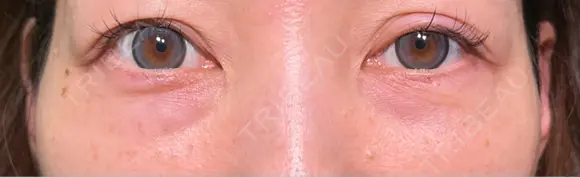 その他（目元） / クマ治療 HAAB×DREAM BEAUTY CLINIC 大阪梅田院 DAY 30 メイン用