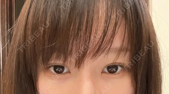 クマ治療 APOLLO BEAUTY CLINIC AFTER メイン用