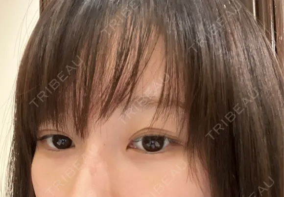 クマ治療 APOLLO BEAUTY CLINIC DAY 12 メイン用