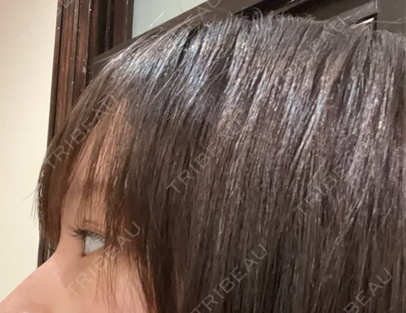 クマ治療 APOLLO BEAUTY CLINIC DAY 12 メイン用