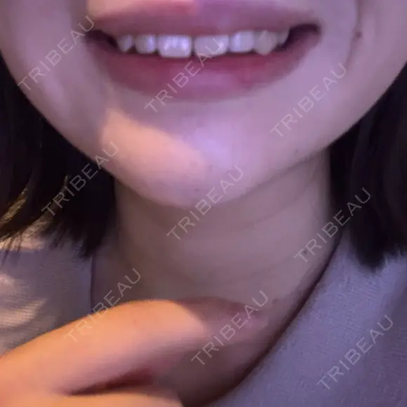 ボトックス（あご） / 肌ヒアルロン酸注入（たるみ・シワ改善） BIZENNクリニック【ビゼンクリニック】 DAY 1 メイン用