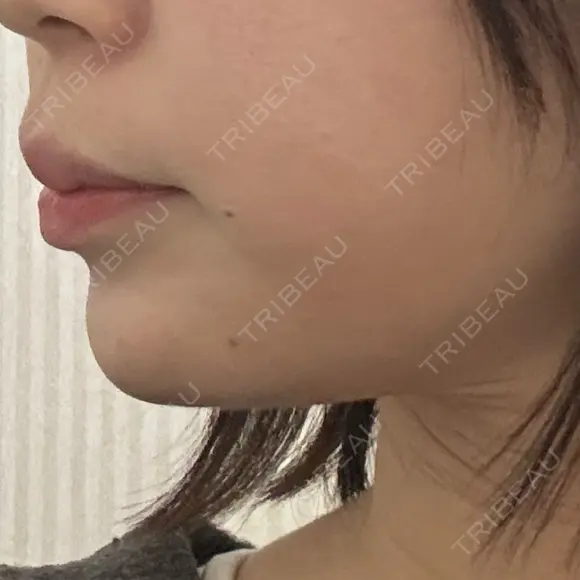 ボトックス（あご） / 肌ヒアルロン酸注入（たるみ・シワ改善） BIZENNクリニック【ビゼンクリニック】 DAY 2 メイン用