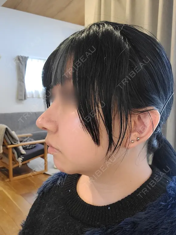 鼻尖形成（切開） / 鼻中隔延長（切開） / 小鼻縮小（切開） / 軟骨移植 / 骨切幅寄せ / 鼻柱下降・鼻唇角形成（猫手術） WOM CLINIC GINZA （ワム クリニック ギンザ） AFTER メイン用