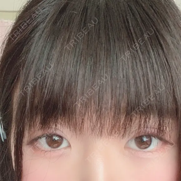 二重切開 / 眼瞼下垂（切開） 広島プルミエクリニック DAY 80 メイン用