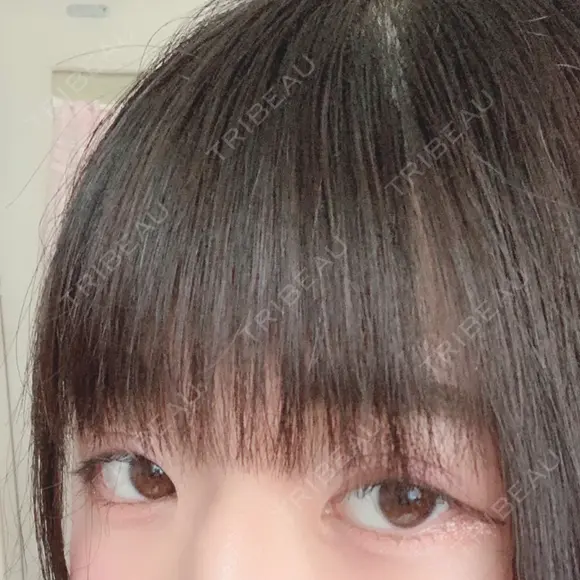 二重切開 / 眼瞼下垂（切開） 広島プルミエクリニック DAY 80 メイン用