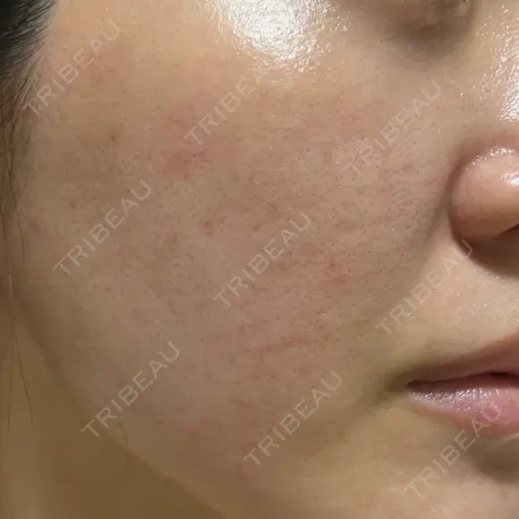 ヴェルヴェットスキン 形成外科と美容外科のクリニック池袋 DAY 17 メイン用