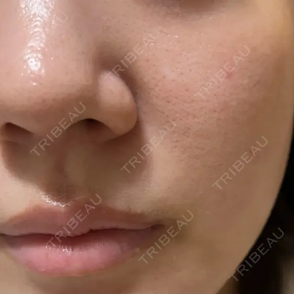 ヴェルヴェットスキン 形成外科と美容外科のクリニック池袋 DAY 17 メイン用