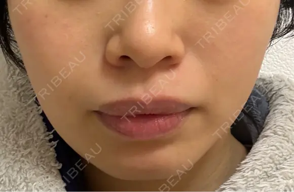 光治療（フォトフェイシャルなど） 品川美容外科 渋谷院（※品川スキンクリニック提携） DAY 4 メイン用