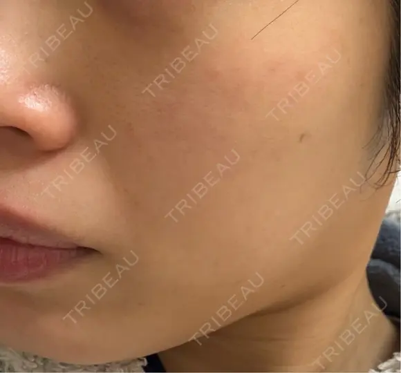 光治療（フォトフェイシャルなど） 品川美容外科 渋谷院（※品川スキンクリニック提携） DAY 4 メイン用