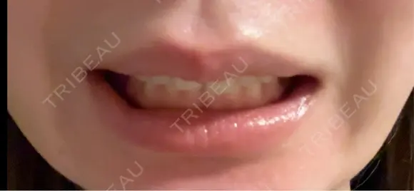 ボトックス（口角） BON BON CLINIC 渋谷院 DAY 7 メイン用