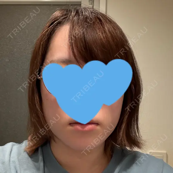 糸リフト / 脂肪吸引（顔） / ジョールファット除去 / 脂肪吸引注射（顔） SEA CLINIC（シークリニック） DAY 11 メイン用