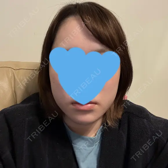 糸リフト / 脂肪吸引（顔） / ジョールファット除去 / 脂肪吸引注射（顔） SEA CLINIC（シークリニック） DAY 12 メイン用