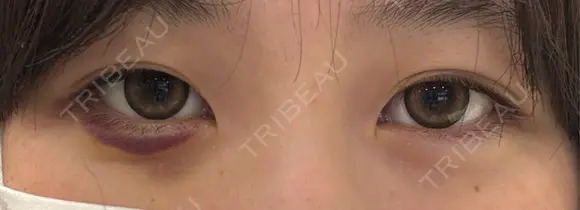 ヒアルロン酸注入（涙袋） / ヒアルロン酸注入（唇） 共立美容外科 梅田院 AFTER メイン用