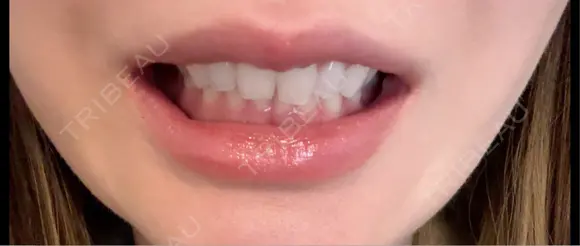 ボトックス（口角） BON BON CLINIC 渋谷院 DAY 9 メイン用